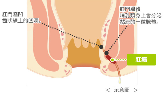 會形成膿液通道的肛瘺