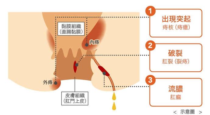 關於名為「痔瘡」的疾病