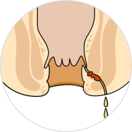 Main symptoms of an anal fistula