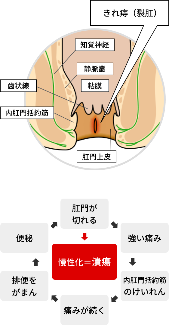 きれ痔（裂肛）のイメージ図